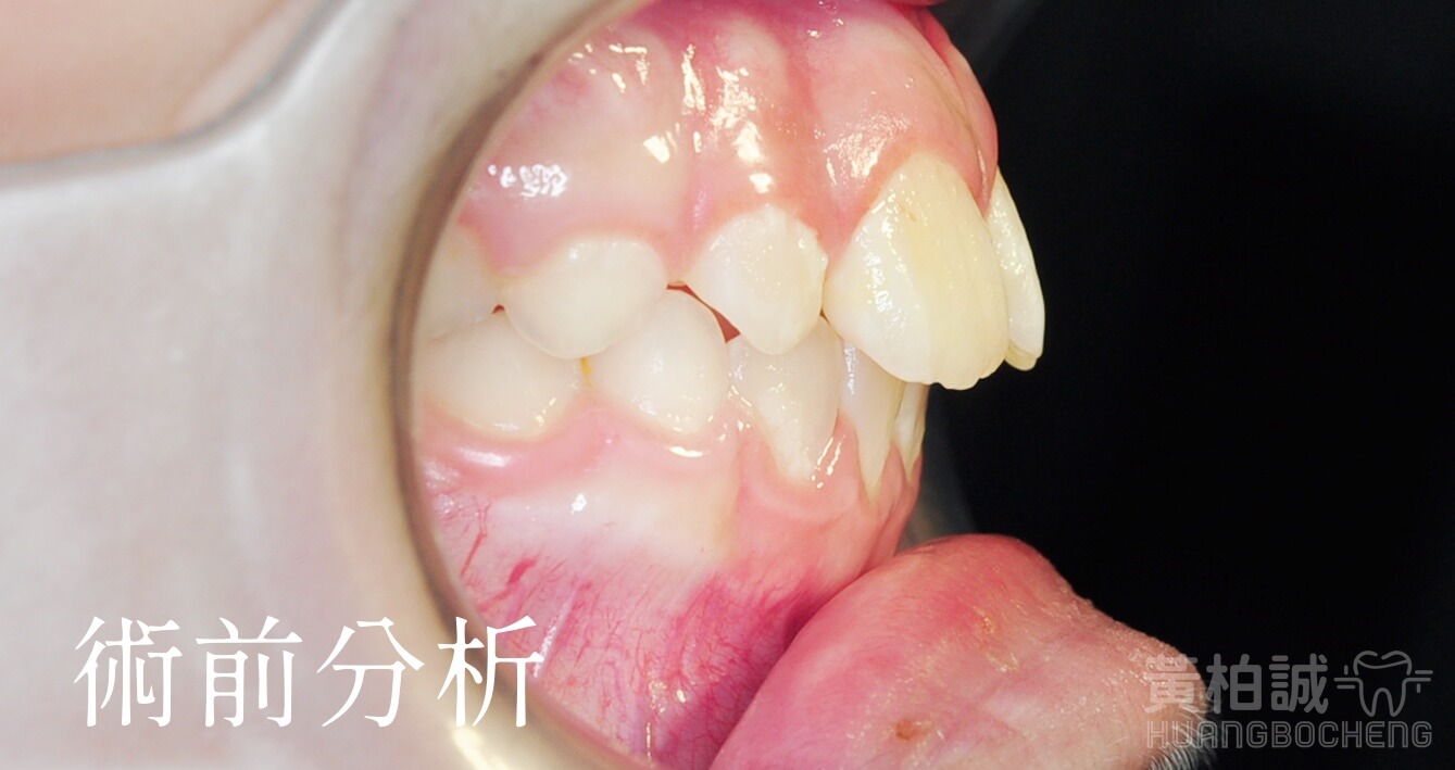 EF矯正器配戴與肌肉訓練