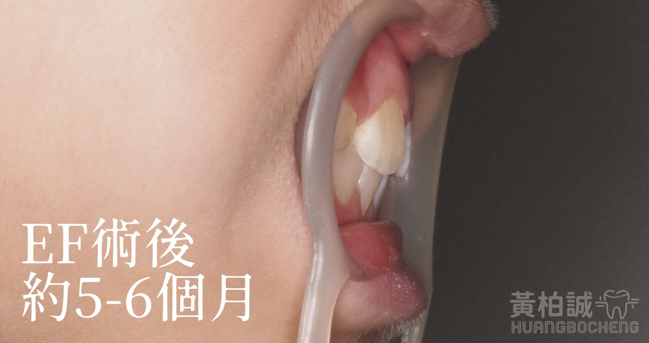 改善顎骨空間與齒列排列