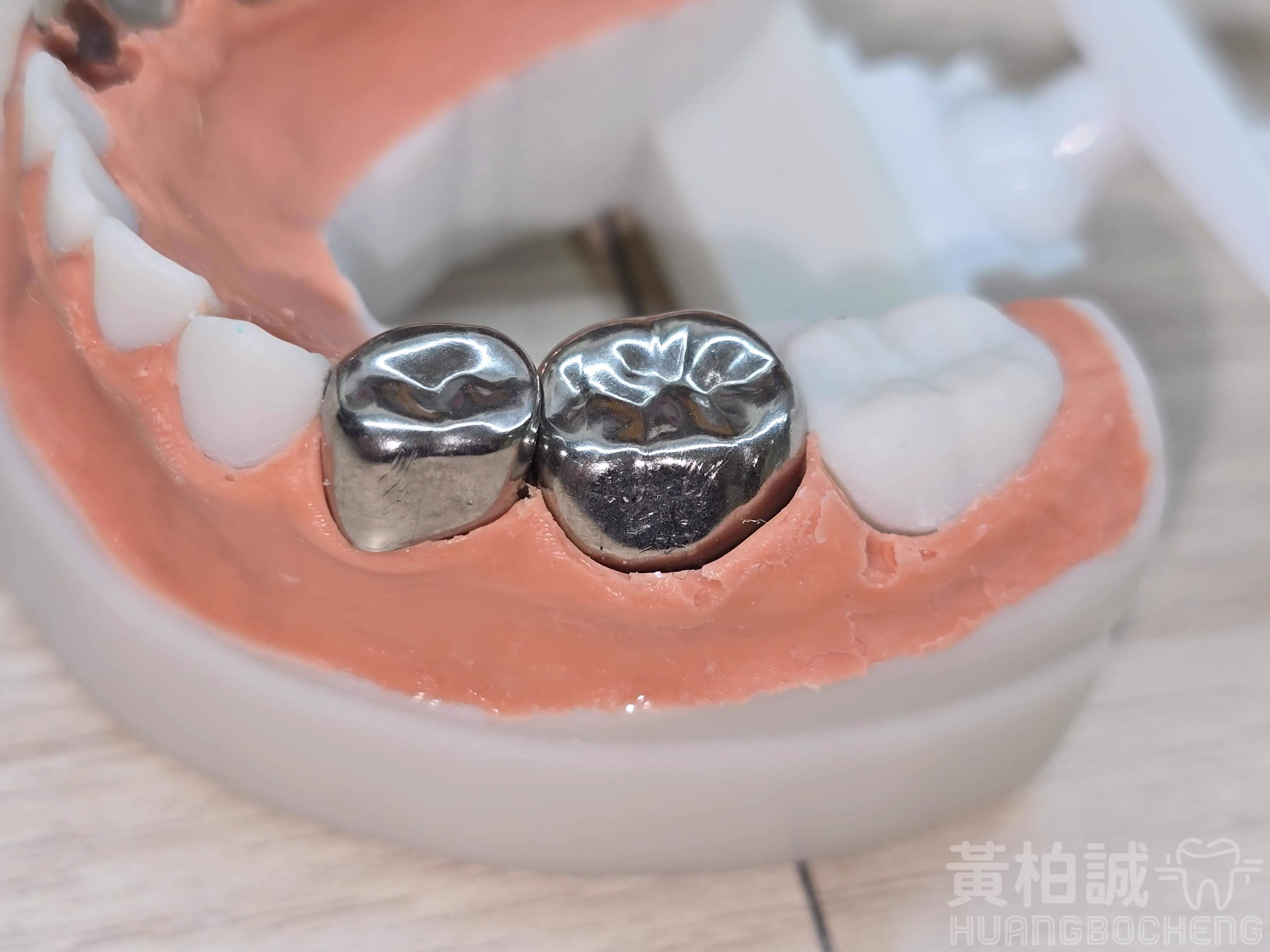 豪式牙套模型示範