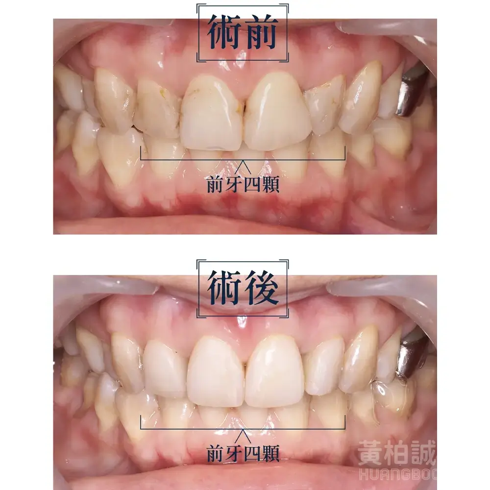 案例三：四顆前牙關縫重建 — 術前術後