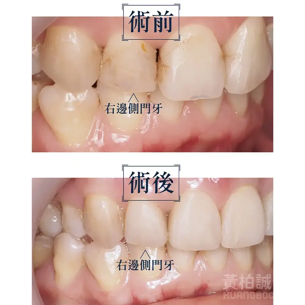 案例四：右側側門牙蛀牙修復 — 術前術後