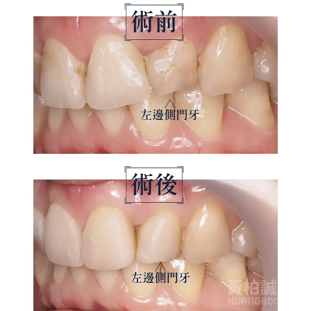 案例五：左側側門牙蛀牙修復 — 術前術後