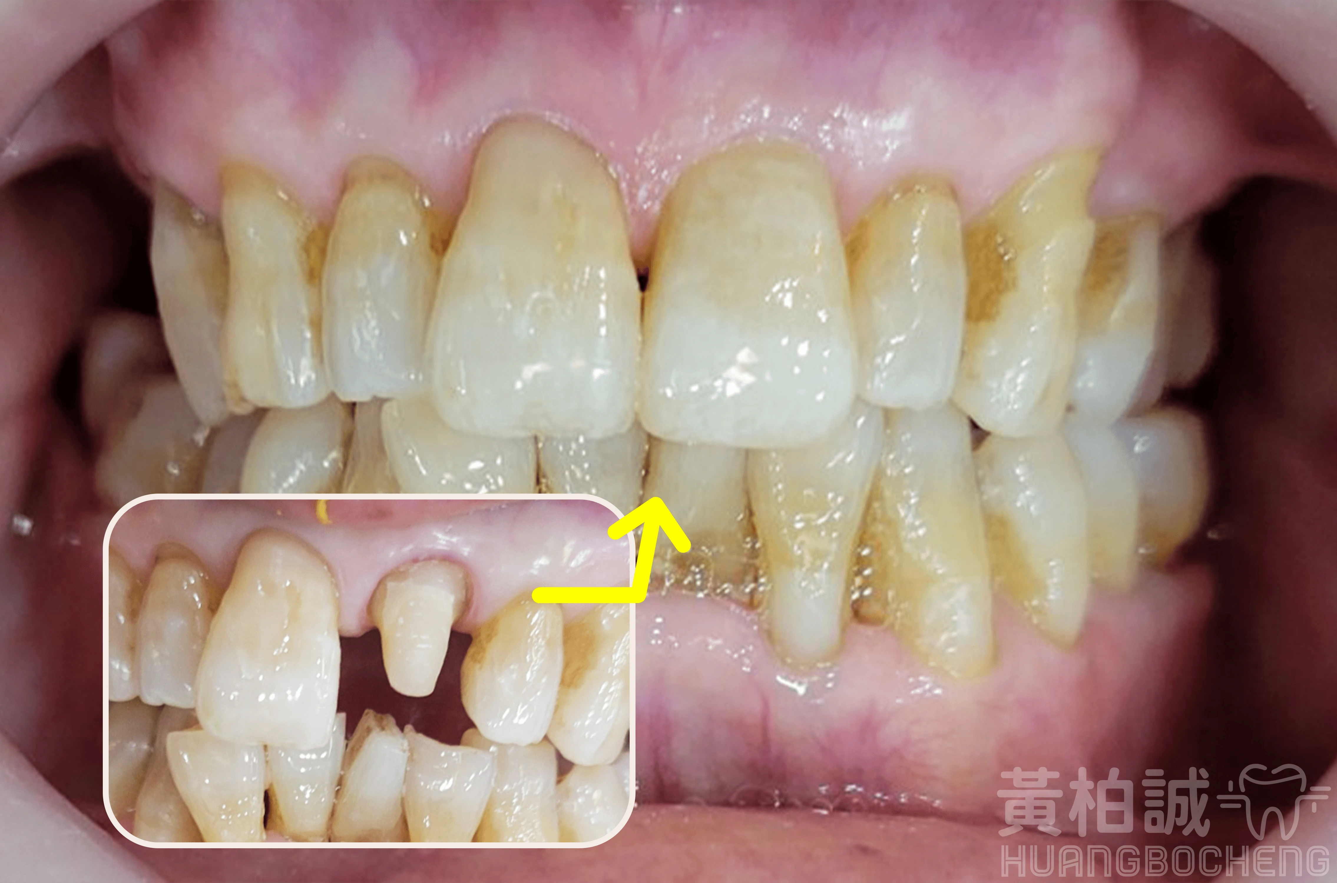 牙冠修復案例一