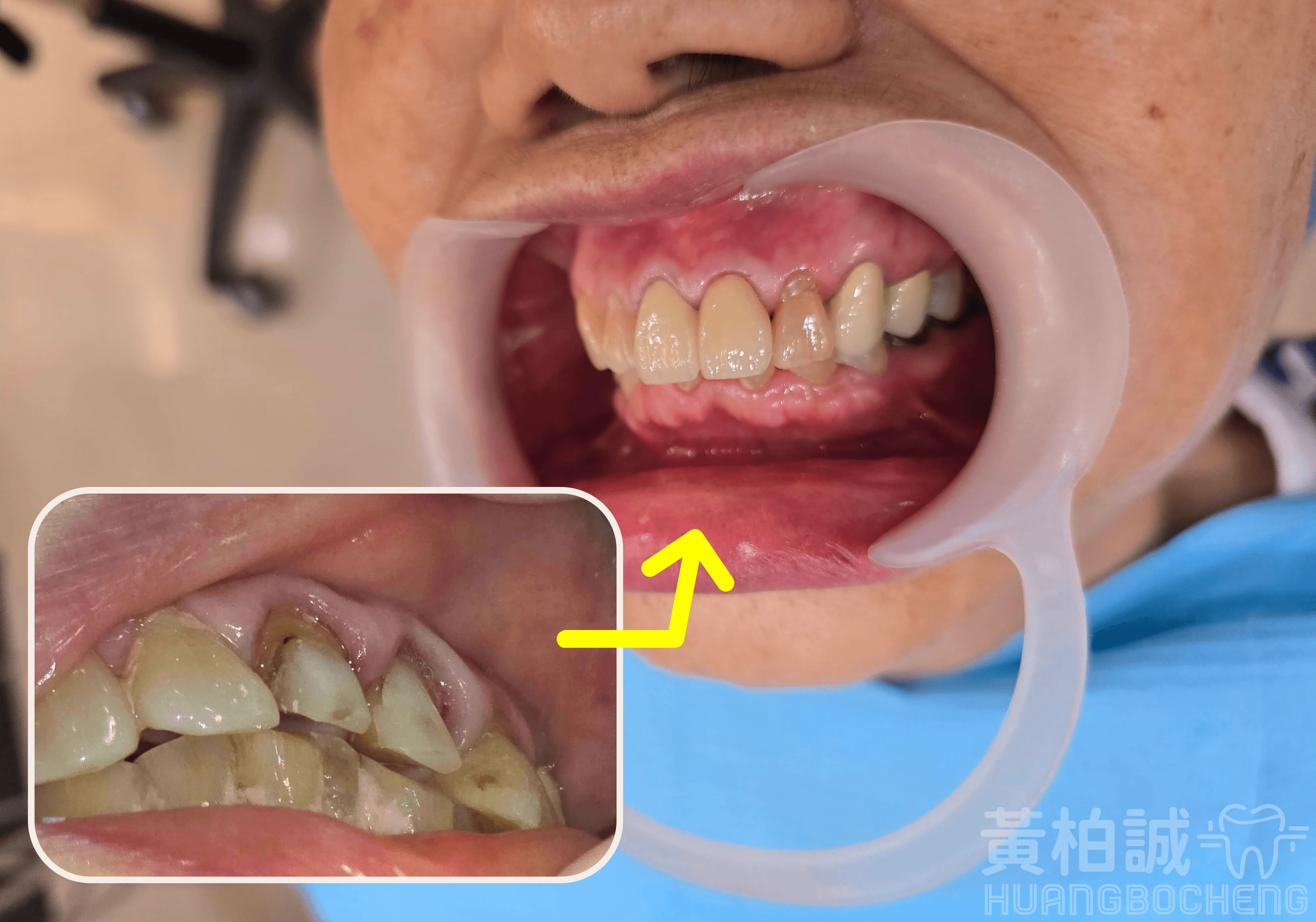牙冠修復案例三