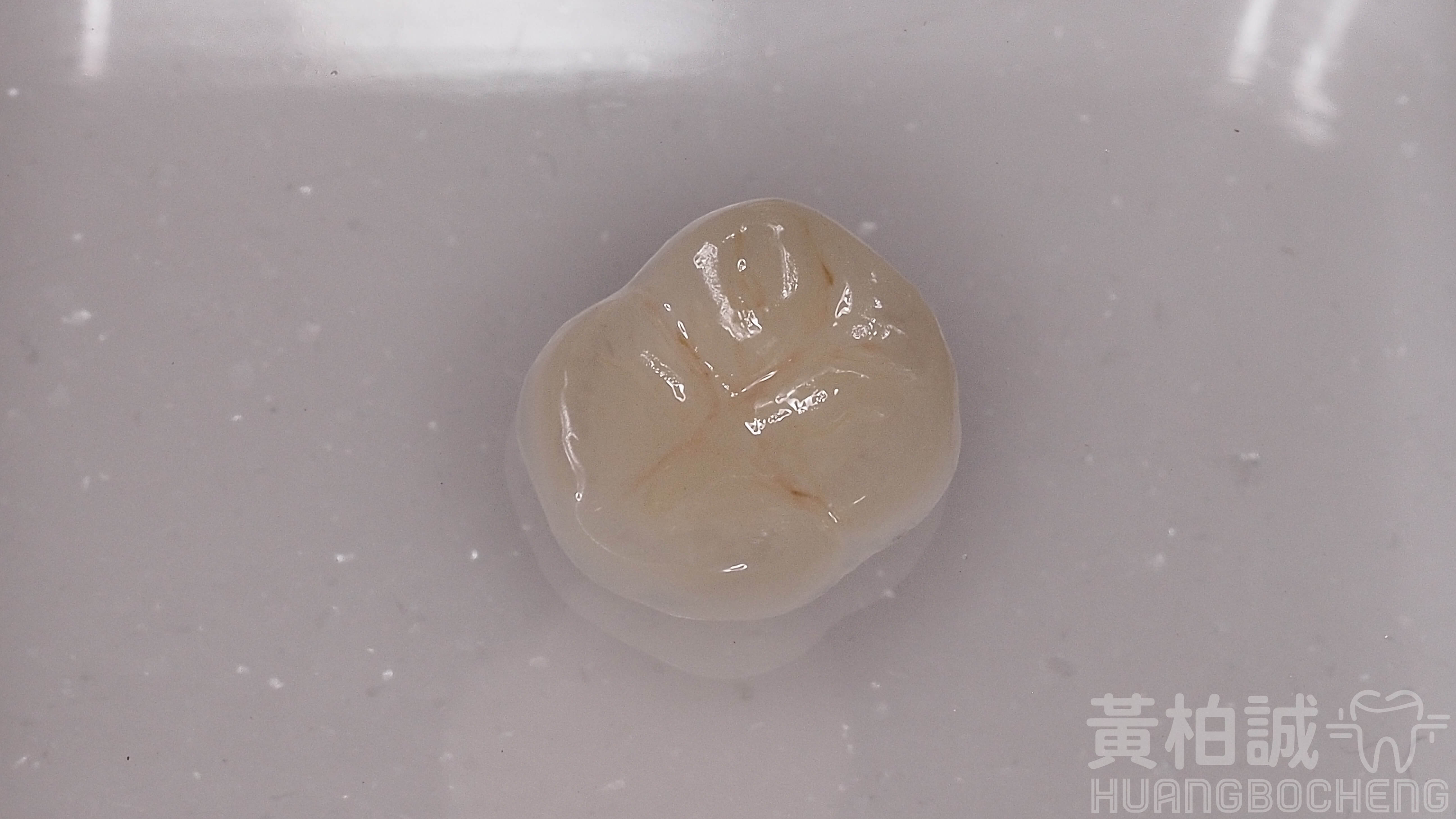嵌體3D齒雕案例圖解