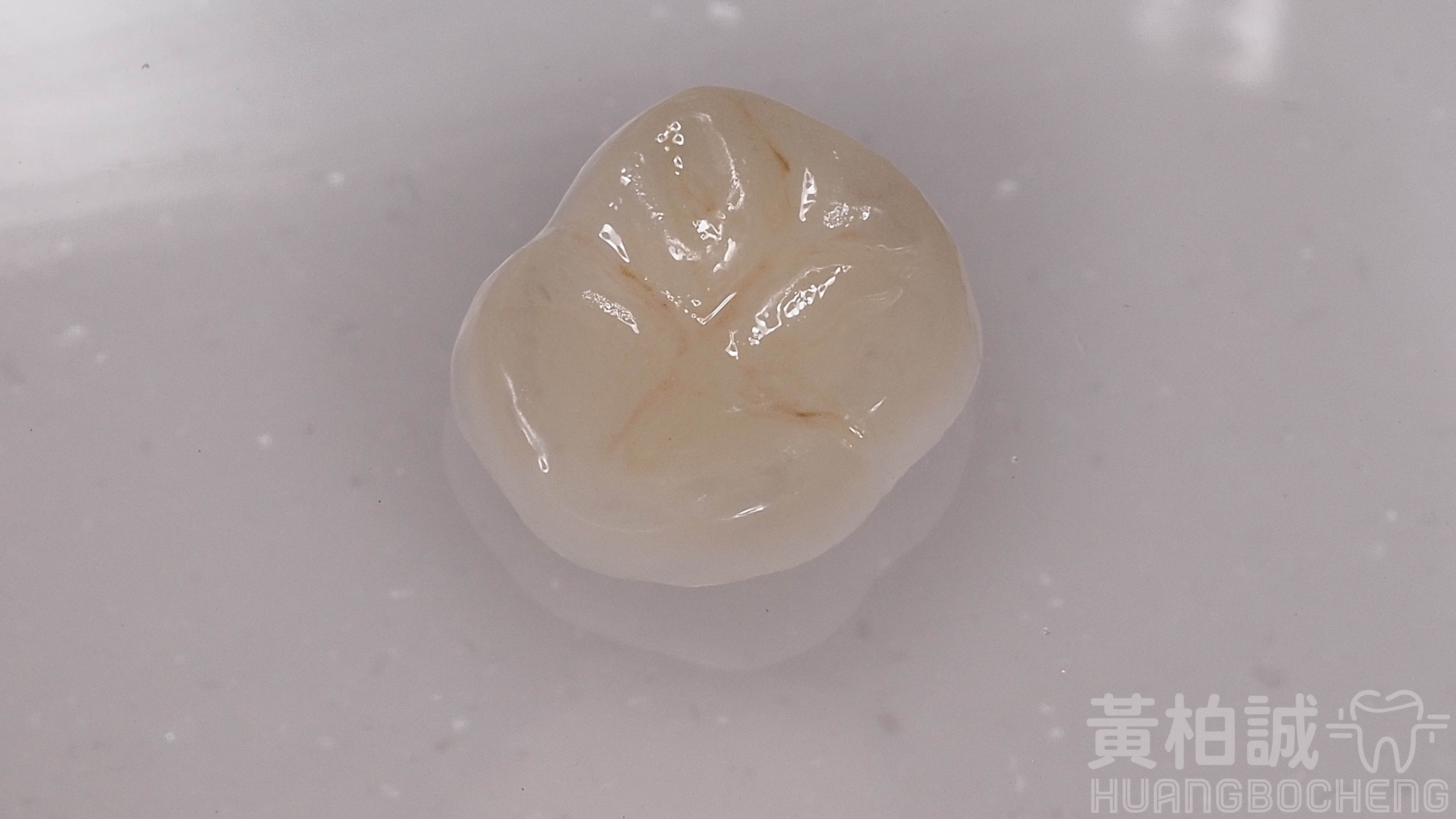 嵌體治療前後對比