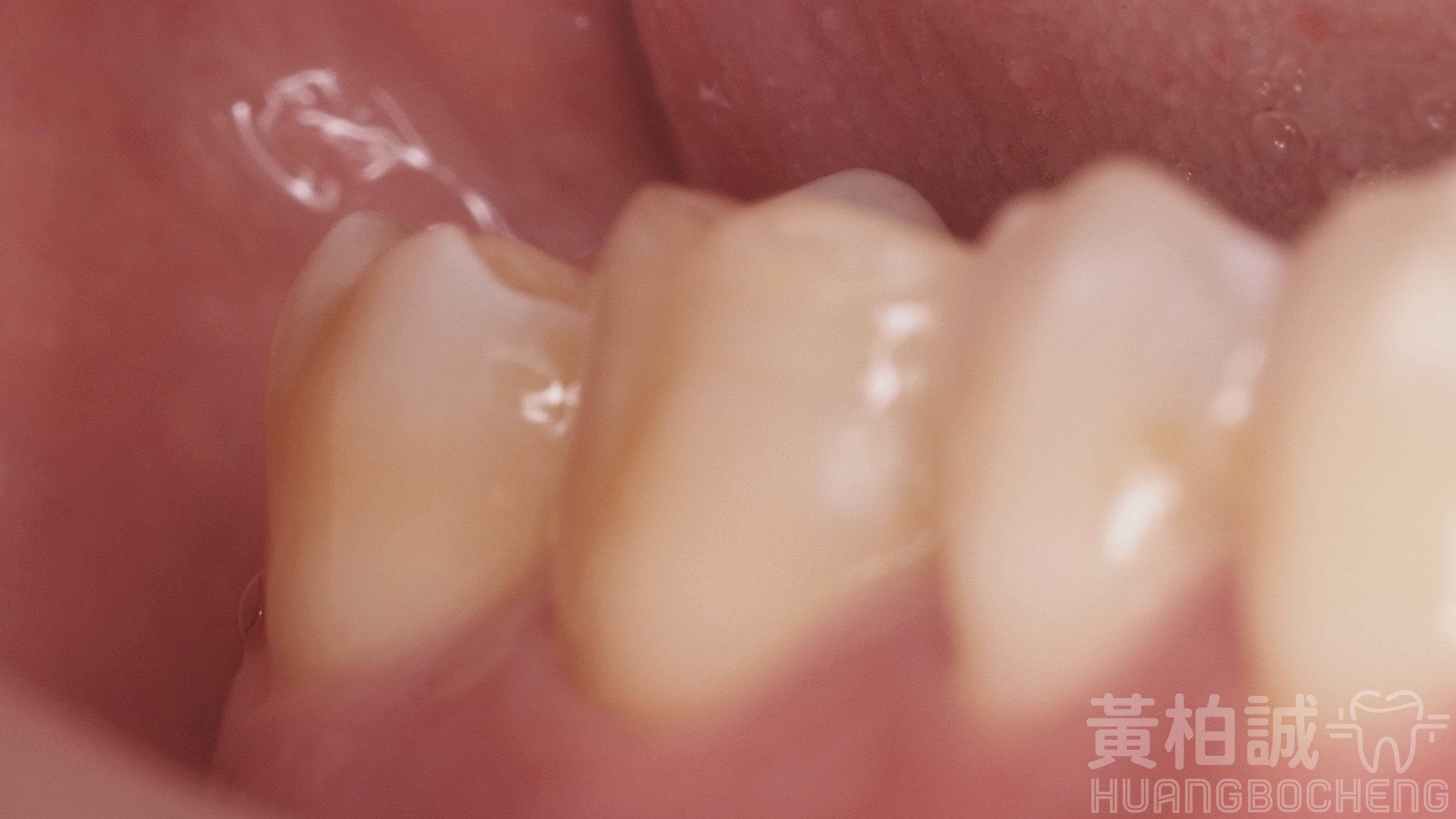 嵌體黏固完成