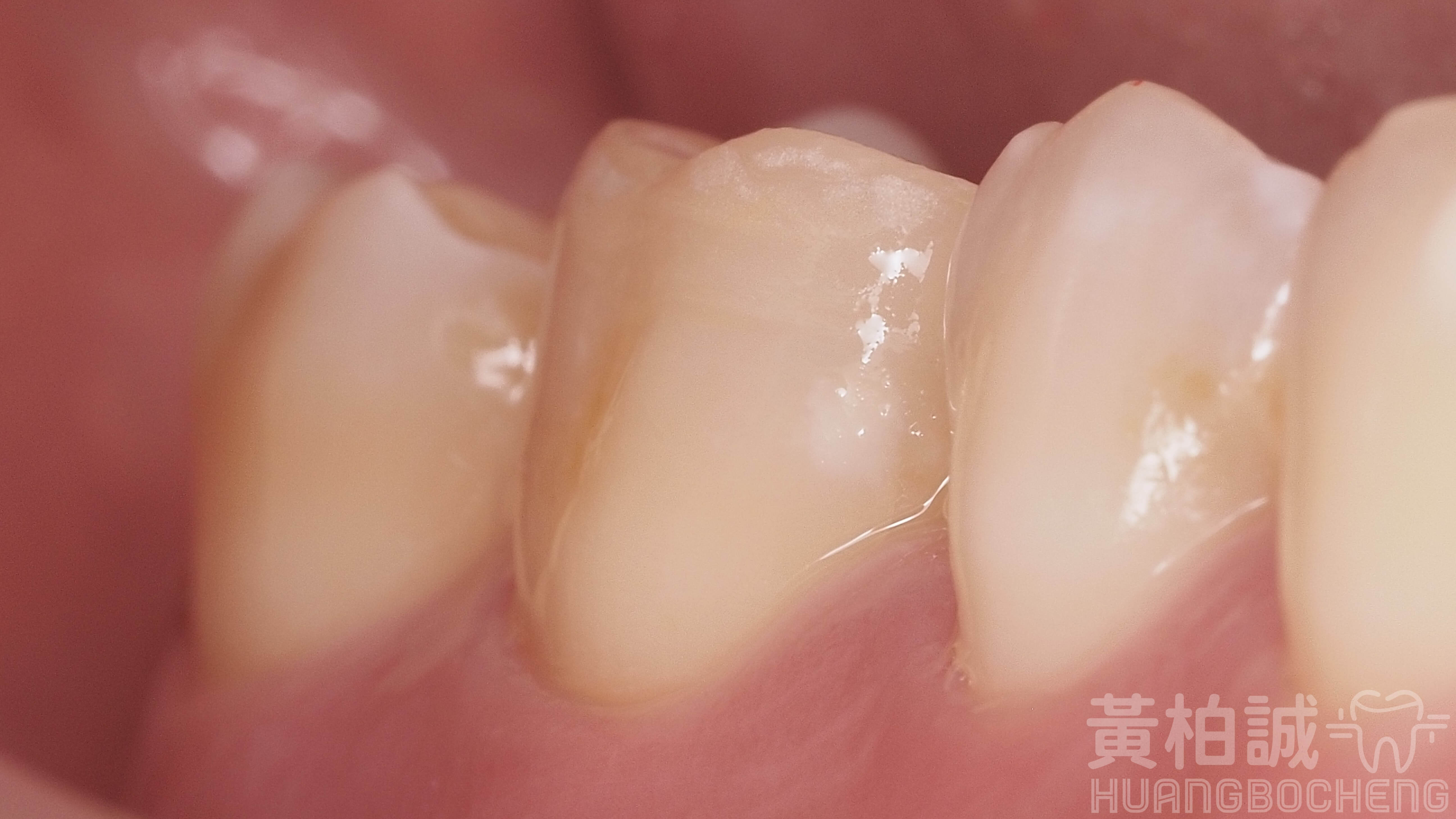 嵌體完成後的口腔狀態