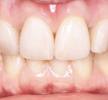 前牙美學示意圖