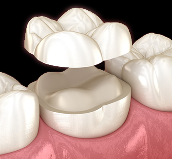 overlay示意圖檔案遺失